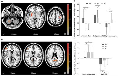 Altered Static and Dynamic Functional Connectivity of Habenula Associated With Suicidal Ideation in First-Episode, Drug-Naïve Patients With Major Depressive Disorder